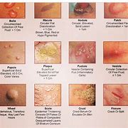 Image result for Types of Skin Eruptions