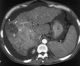 Image result for Hepatic Cysts Liver