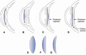 Image result for Intraocular Space