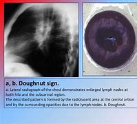 Image result for Donut Sign CXR