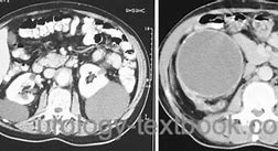 Image result for Renal Cyst Simple On CT with and without Contrast