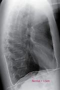 Image result for Chest Diaphragm