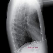 Image result for Diaphragm Pain Symptoms