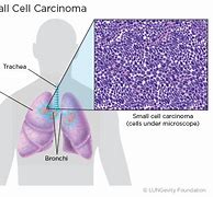 Image result for Small Cell Lung Cancer Types