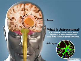 Image result for astrocytoma