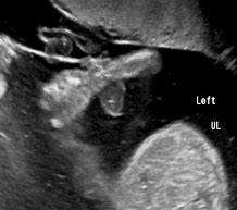Image result for Amniotic Band Syndrome Ultrasound