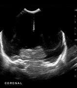 Image result for Hydranencephaly Assymptomatic