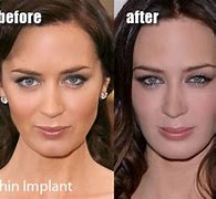 Image result for Emily Blunt Veneers