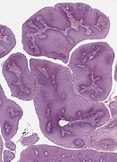 Image result for Extensive Condyloma