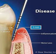 Image result for Gingival and Periodontal Pocket