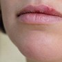 Image result for Allergic Reaction around Lips
