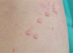 Image result for Molluscum Contagiosum Toddler Treatment