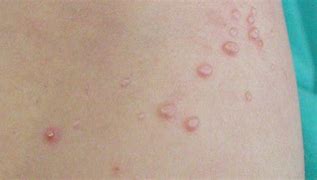 Image result for Molluscum Contagiosum vs Genital Warts