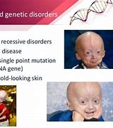 Image result for Gene Mutation Disease