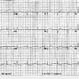 Image result for Echocardiogram Mercedes Sign