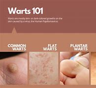 Image result for Common Flat Warts