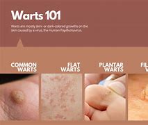 Image result for Head Warts