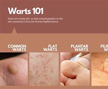 Image result for Skin Warts On Face