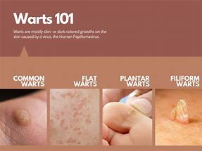 Image result for Water Warts in Adults