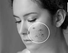 Image result for Different Kinds of Acne in Your 30s