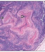 Image result for Lymphogranuloma Venereum