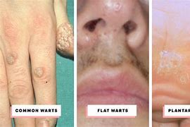 Image result for Types of Warts On Back