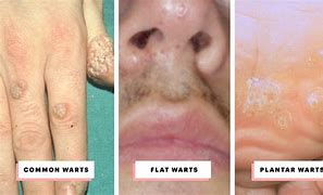 Image result for Gross Warts