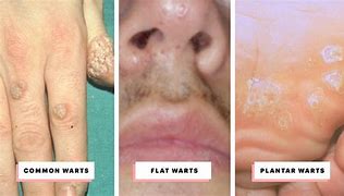 Image result for Common Skin Warts