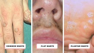 Image result for Skin Wart Pictures