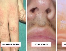 Image result for Common Wart Forearm