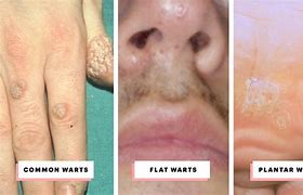 Image result for Filiform Wart or Skin Tag