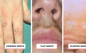 Image result for Filiform Wart Skin