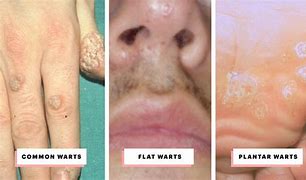 Image result for Wart in Nose