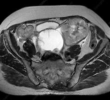 Image result for Ovarian Cancer On X-ray
