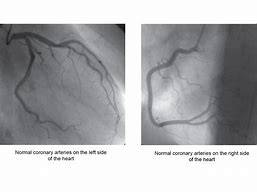 Image result for Coronary Angiogram Model