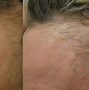 Image result for Minoxidil Results Women