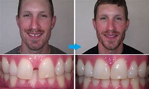 Image result for Invisalign Gap