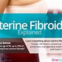 Image result for Fibroids in Uterus Symptoms
