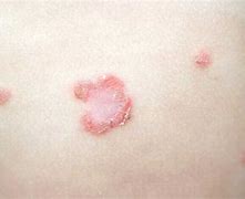 Image result for Impetigo Skin Infection