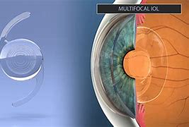Image result for Implanted Lenses