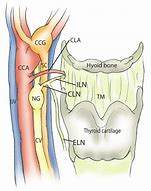 Image result for Vagus Nerve and Carotid Sinus