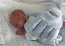 Image result for Premature Baby 2Lb