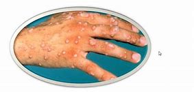 Image result for Human Papillomavirus Symptoms
