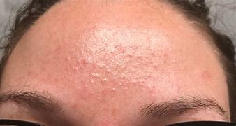 Image result for Flesh-Colored Bumps On Cheeks