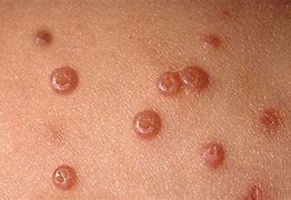 Image result for Molluscum Contagiosum Pictures Early Stages