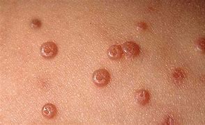 Image result for Extensive Molluscum Contagiosum