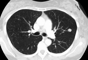 Image result for Left Upper Lobe Lung Nodule