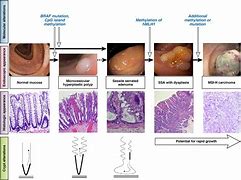 Image result for One.6 mm Sessile Polyp
