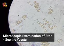 Image result for What Does Candida Look Like in Stool