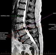 Image result for MRI of Lumbar Spine